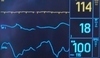 Elektrokardiogram